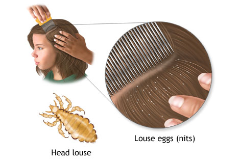 Head Lice